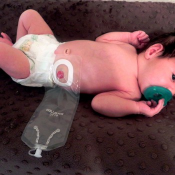 10-Tips-for-Your-Baby’s-Colostomy-Care