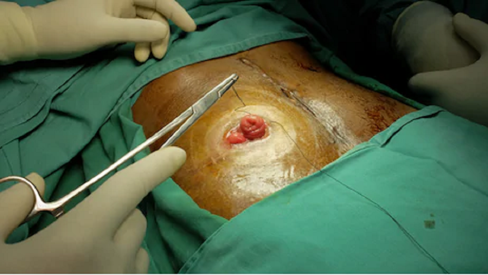 stoma 3web